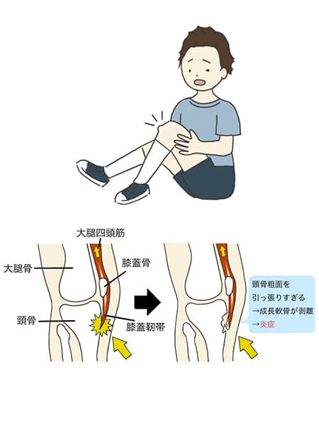 オスグッドのイラスト